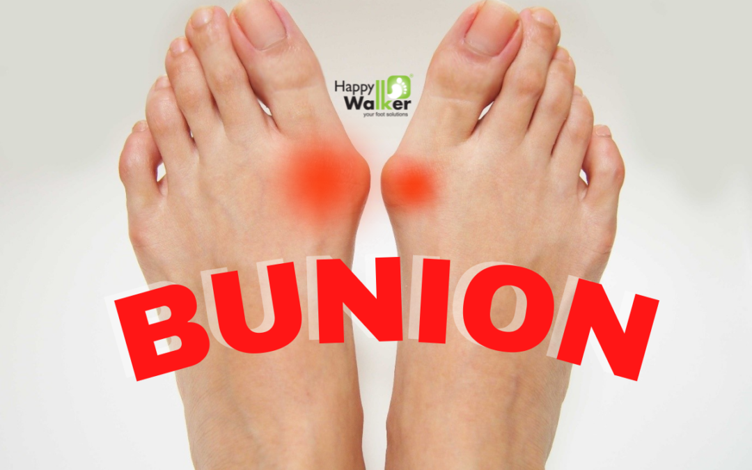 Don’t Overlook Your Bunion! May Affect your Posture Result in Pain
